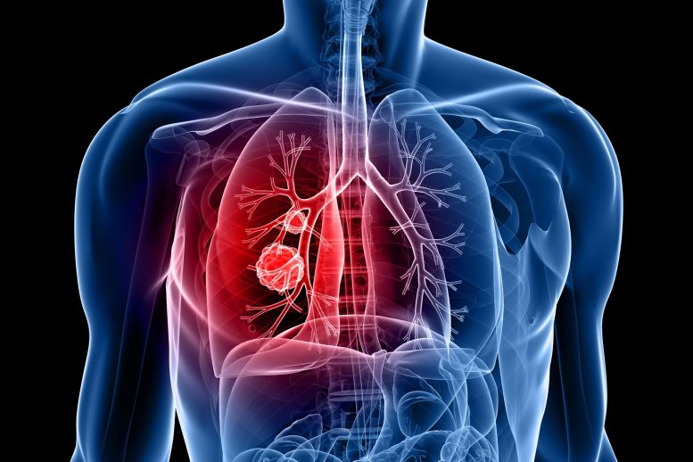 肺癌图