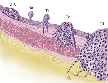 非肌肉浸润性膀胱癌（Ta、T1 和 CIS）的管理策略