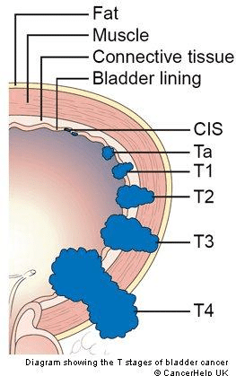 bladder-cancer-stage-cis-carcinoma-in-situ-small-lesion-in-the-innermost-layer-of-the.png