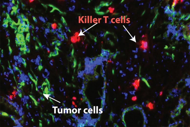 显微镜拍摄的胰腺癌细胞