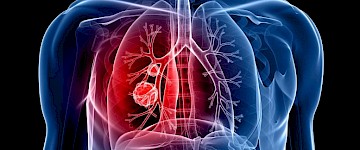 中国科学家对肺癌提供了新诊断和靶向治疗方法